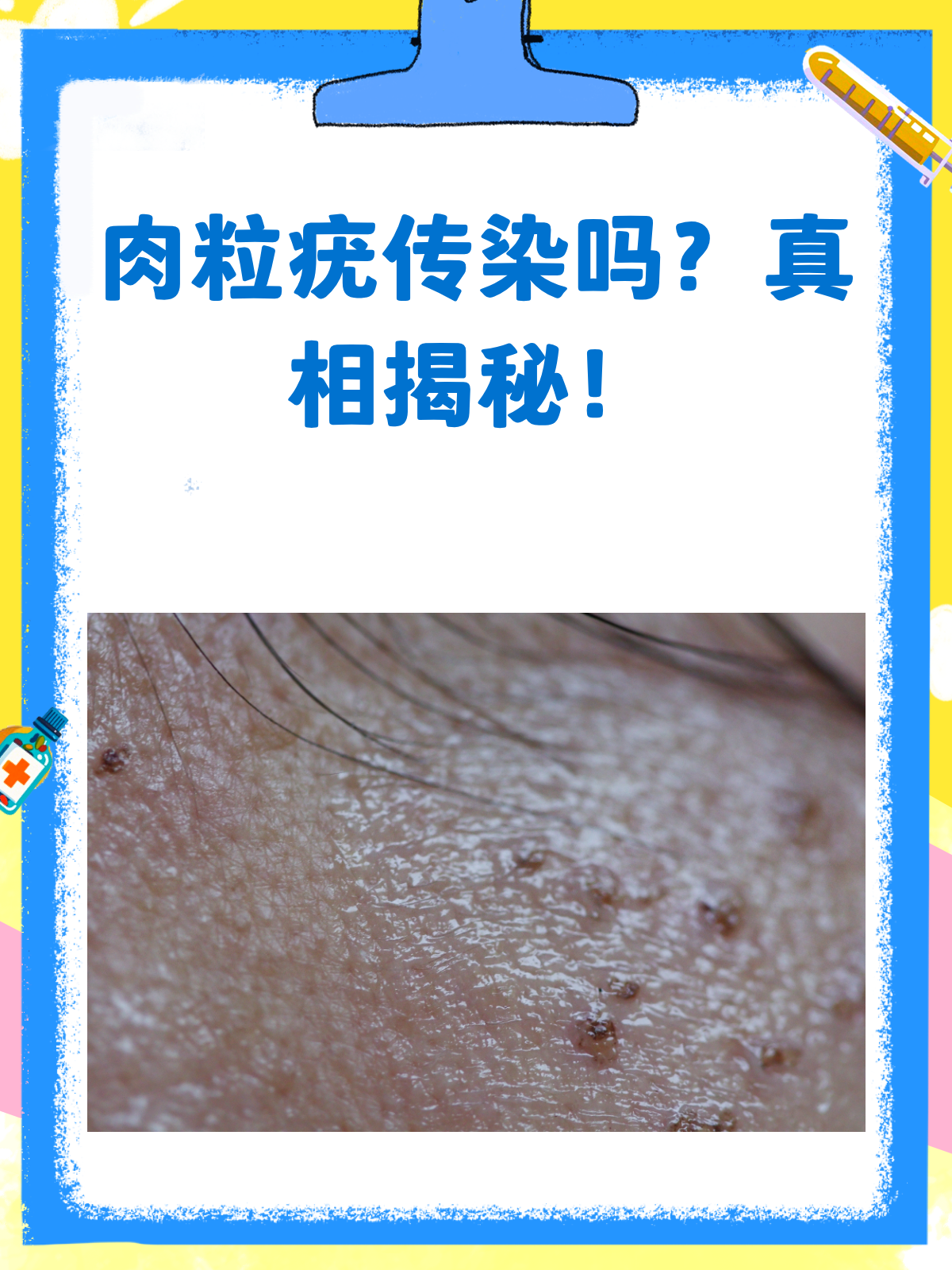 肉粒疣会传染吗?答案在这里!