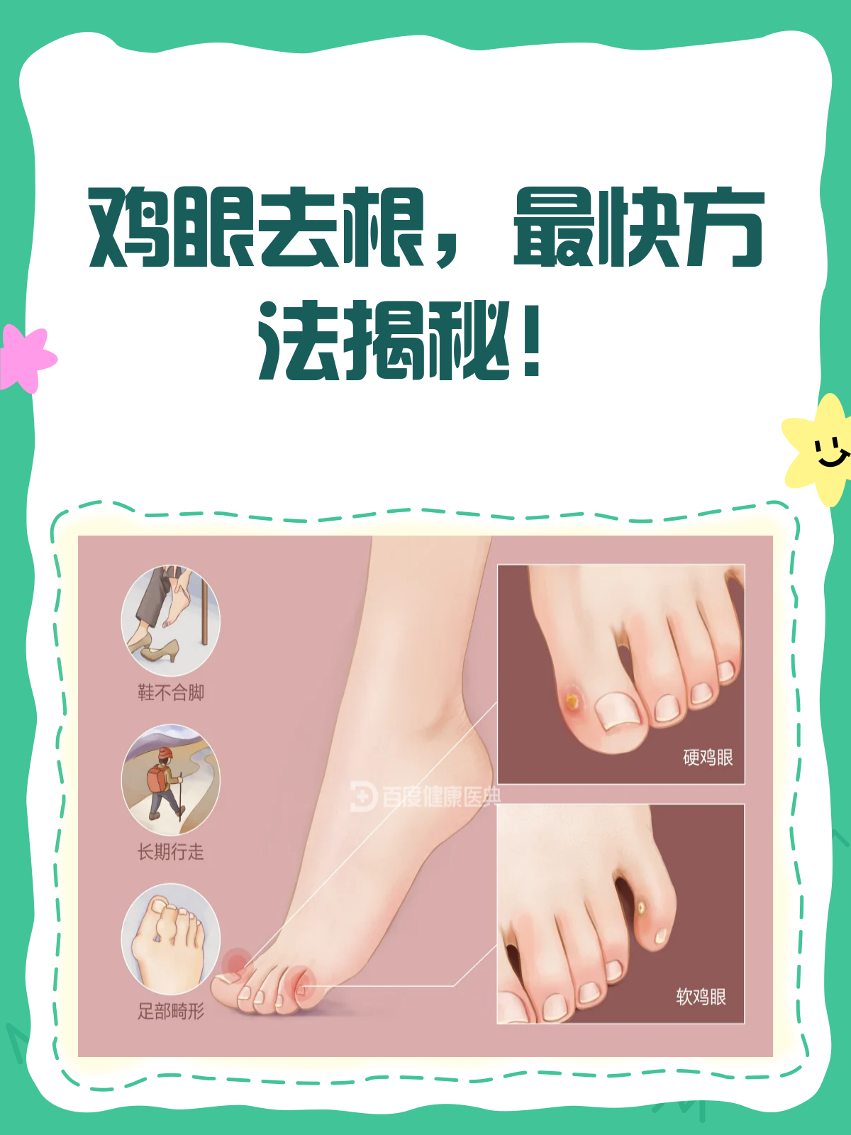 鸡眼去根最快方法揭秘!