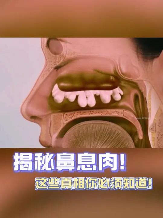 揭秘鼻息肉!这些真相你必须知道!一起来揭秘鼻息肉背后的秘密! 鼻息肉的症状及危害鼻息肉鼻窦