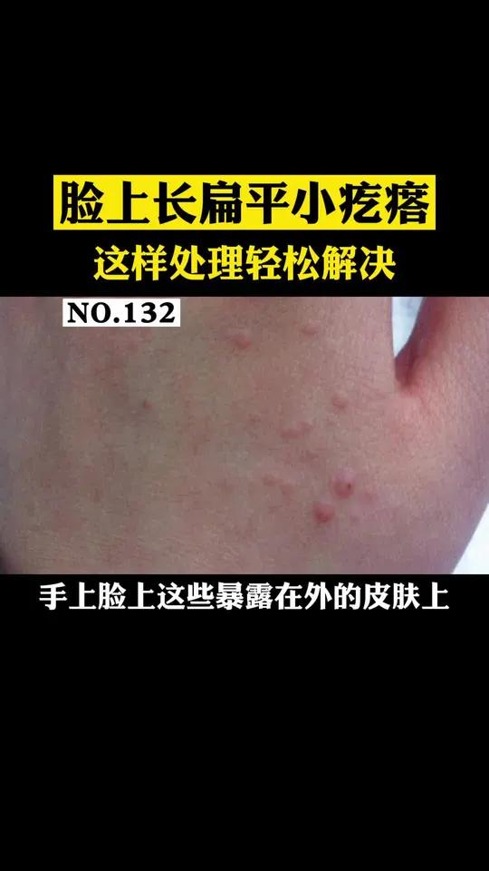 手上或者脸上长这种凸起的扁平小疙瘩,这可能是扁平疣,处理起来非常简单