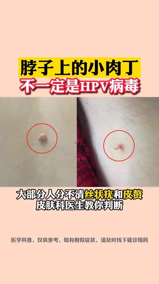 脖子上长小肉粒,皮肤科医生教你判断丝状疣和皮赘