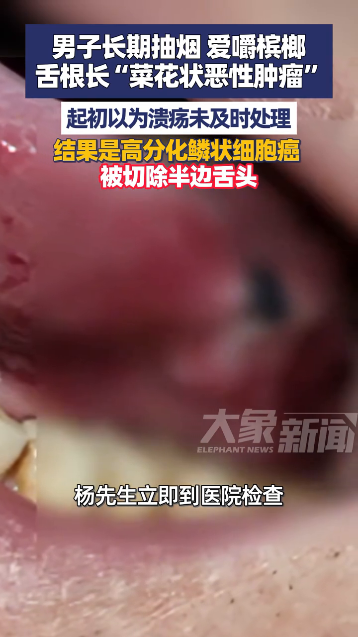 男子长期抽烟爱嚼槟榔,舌根长菜花状恶性肿瘤