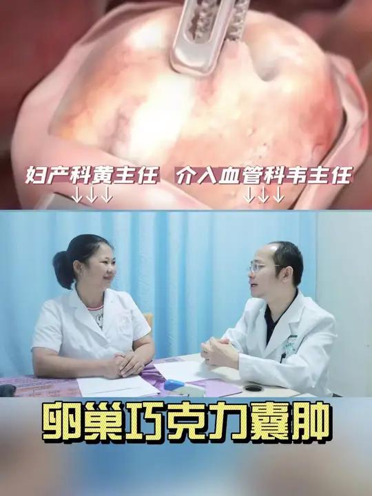 卵巢巧克力囊肿妇科知识#卵巢巧克力囊肿