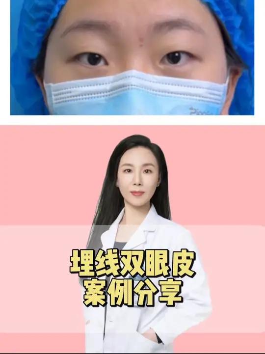 小美女稍微有点肿眼泡，上眼皮肉肉的，让我们看看埋线后的效果吧～双眼皮埋线