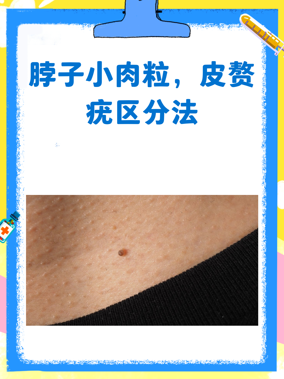 脖子长小肉粒?一文教你分清皮赘和疣!