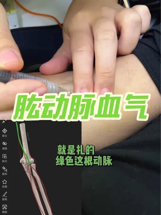 这动脉!谁懂我同事一针见血的含金量「泣不成声」肱动脉穿刺 肱动脉采血 血气分析