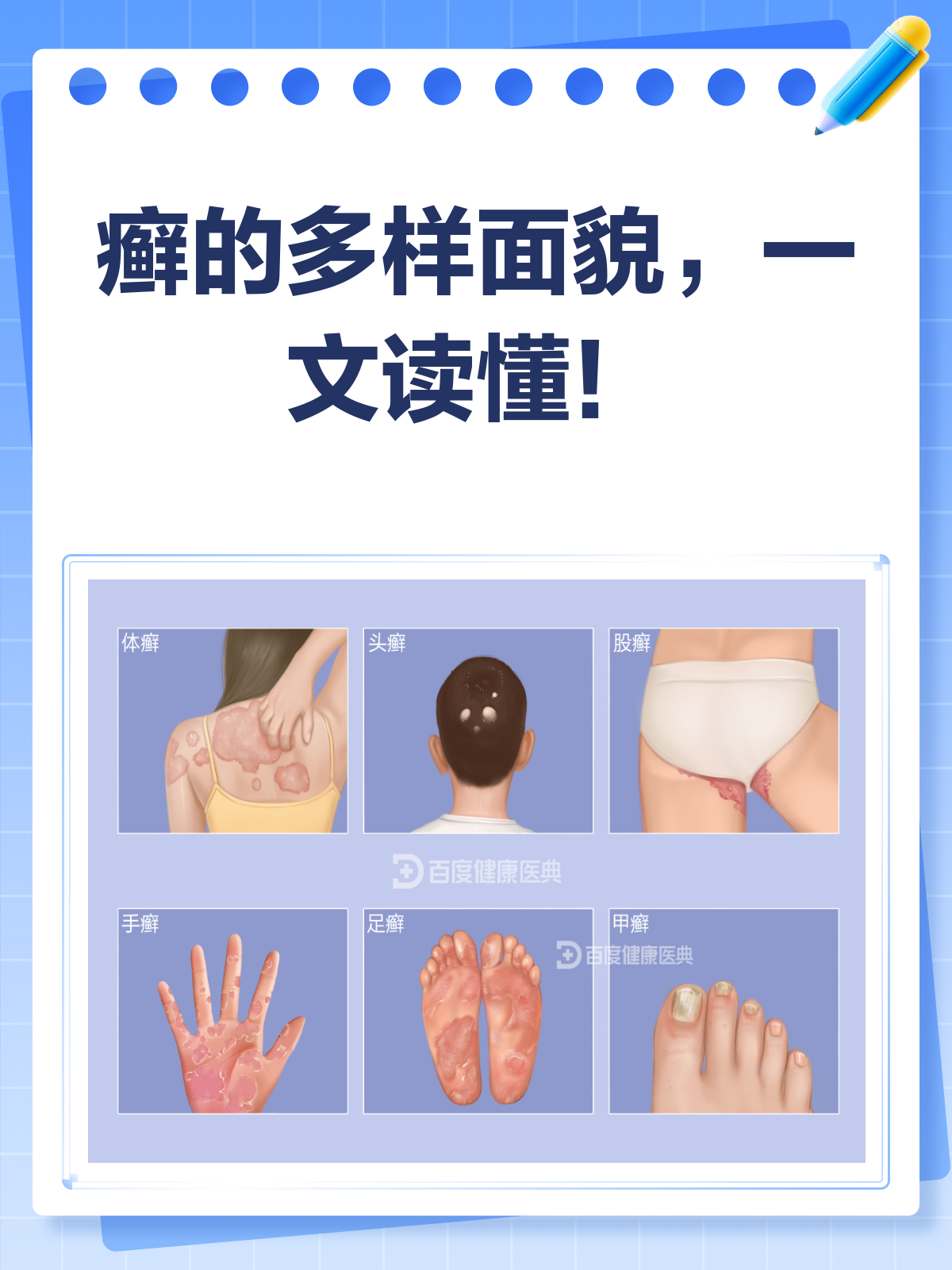 揭秘癣的真面目!不同部位,样子大不同
