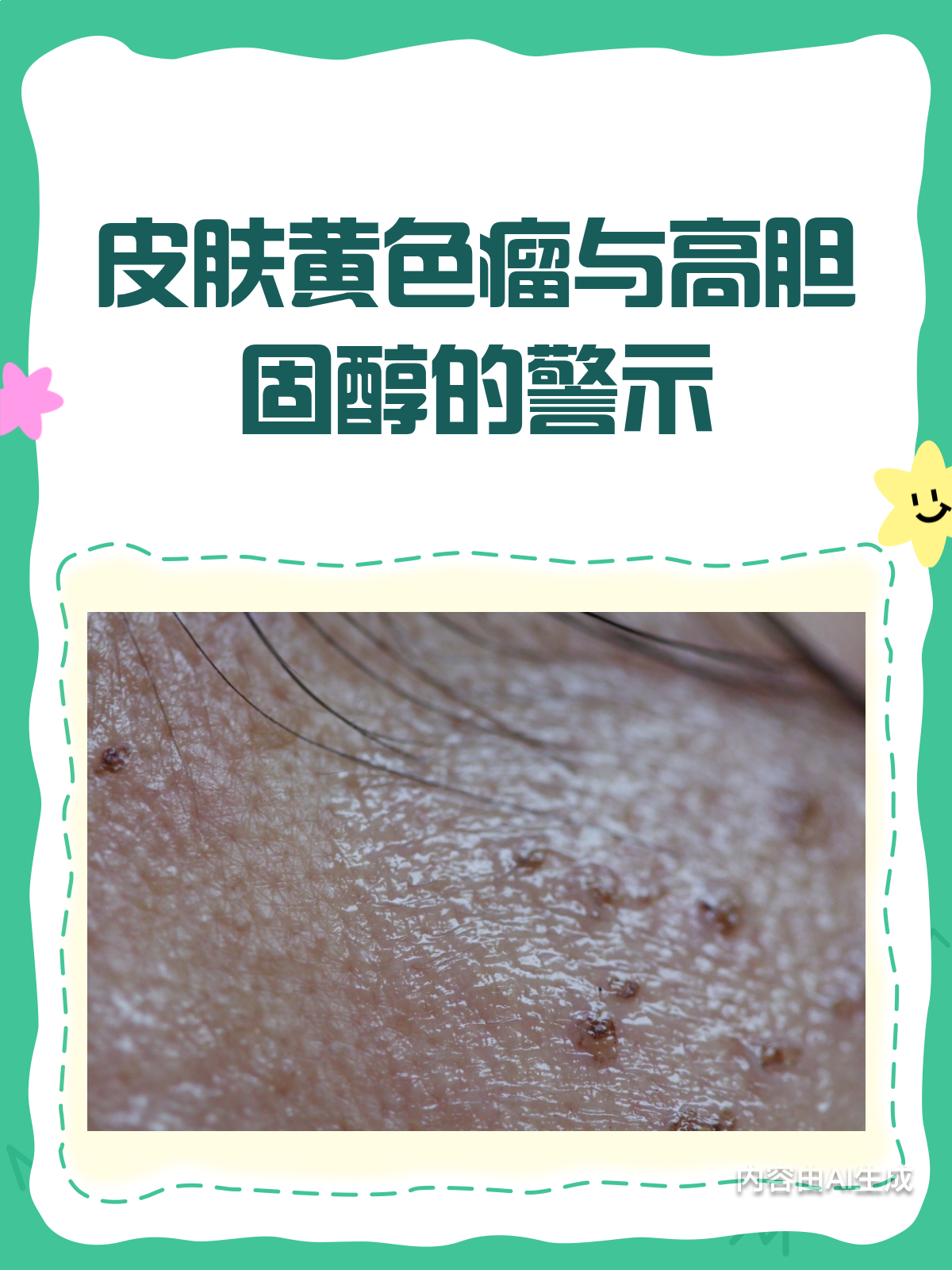 眼皮上长“痘痘”?警惕皮肤黄色瘤!