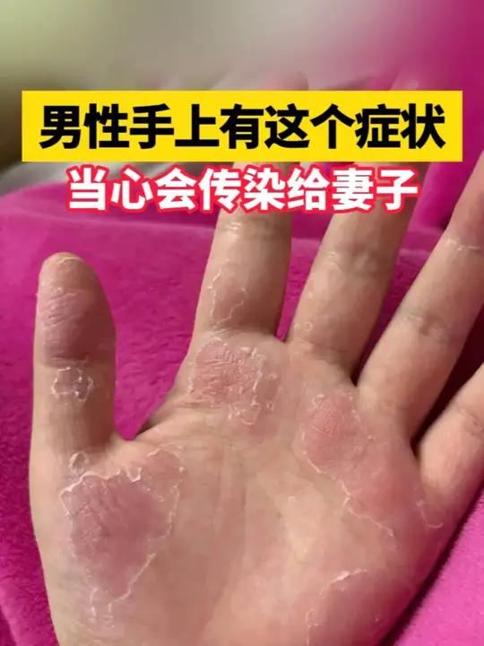 很可能是脚气传染到了手上,手癣这样处理好的快!