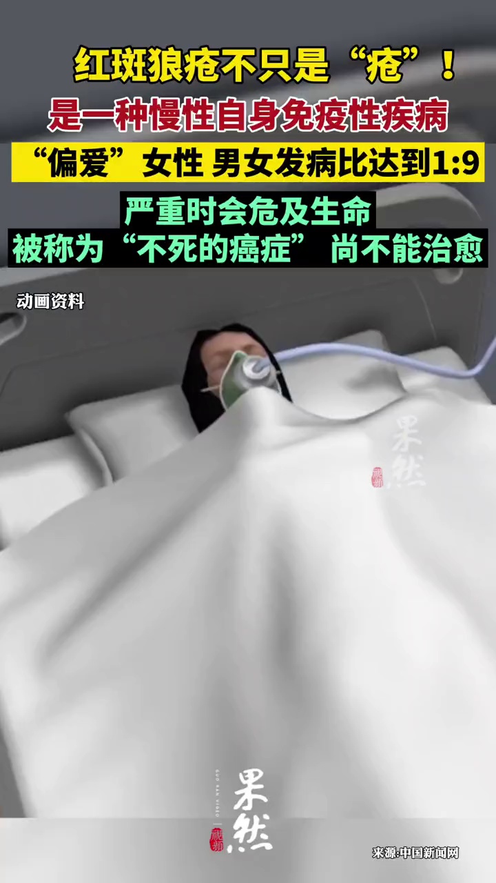 红斑狼疮不只是“疮”!