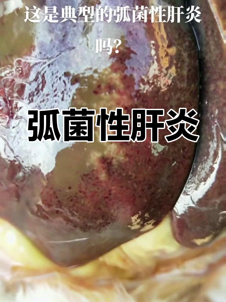 慢性弧菌感染导致鸡消瘦、肝坏死,出血斑明显