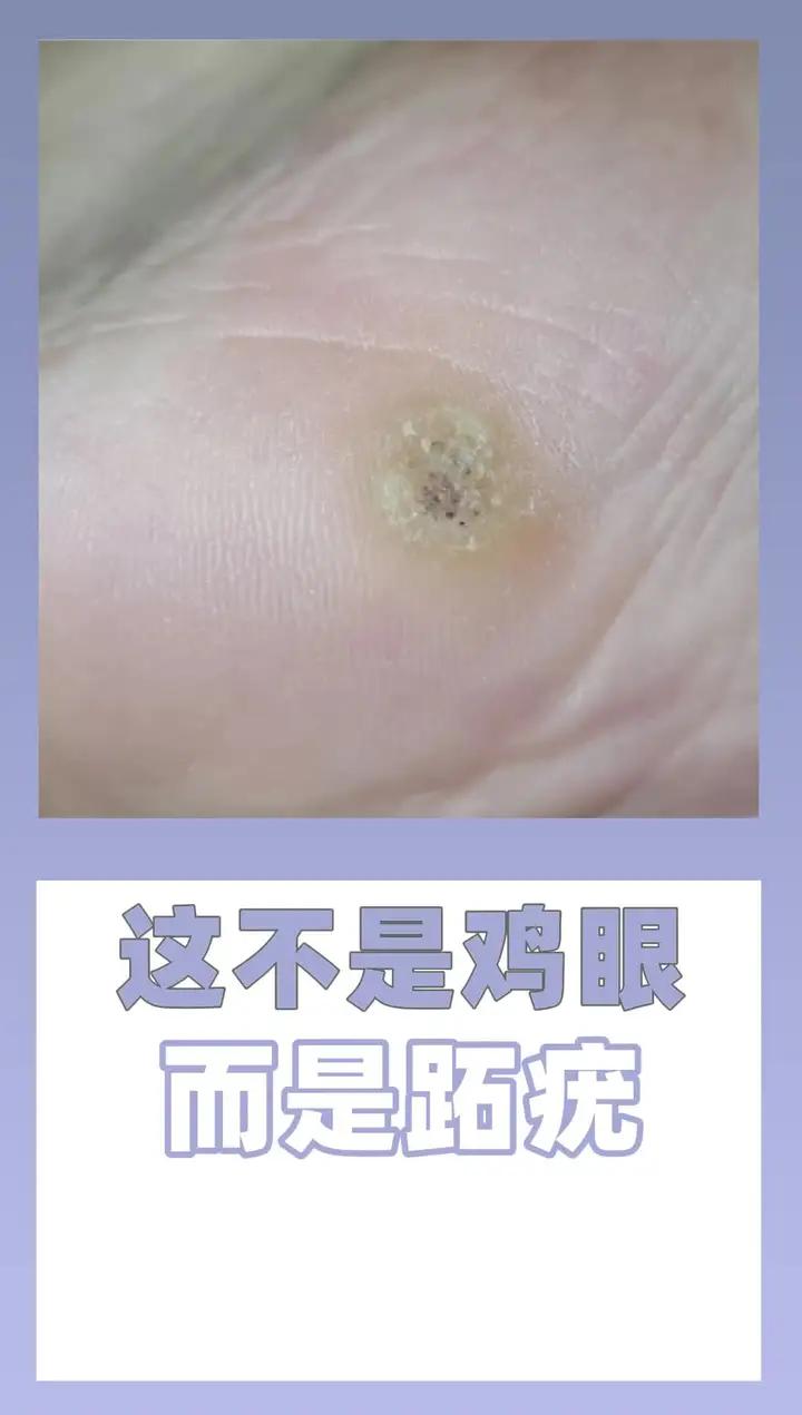 这不是鸡眼 而是跖疣
