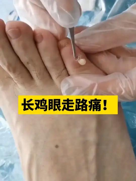 长了鸡眼,走路都觉得痛!跟着医生这样处理简单又方便