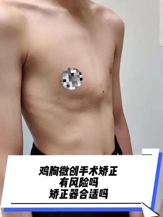 鸡胸,微创手术有风险吗