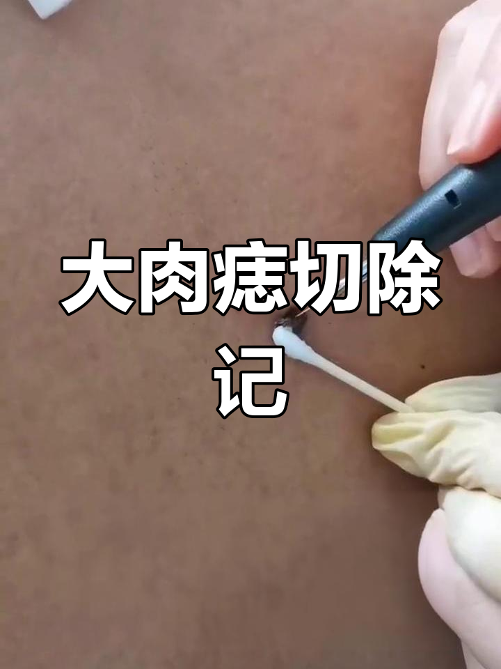 30岁男子背部惊现大肉痣,决定手术切除!