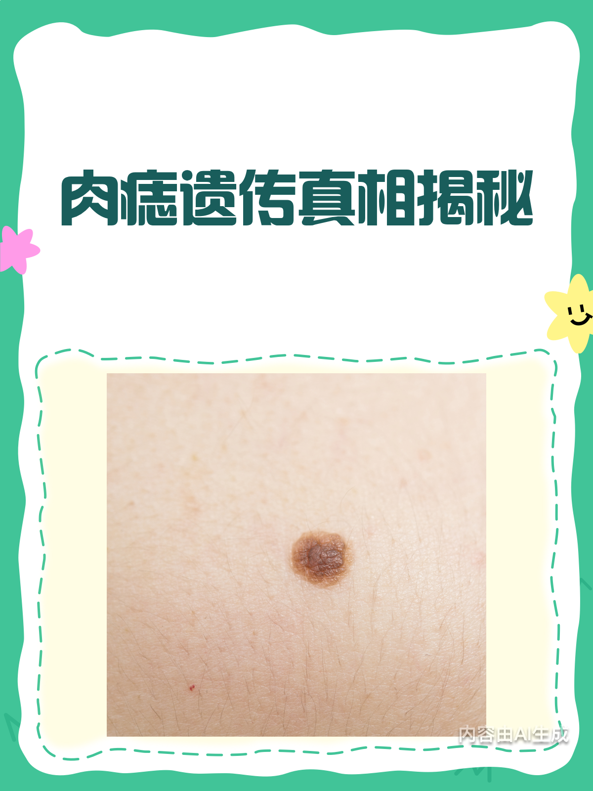 肉痣会遗传给下一代吗?看完就懂了!