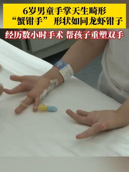 6岁孩子手掌天生畸形,“蟹钳手”形状如同龙虾的钳子。医生为孩子实施高难度矫形手术,帮助他重