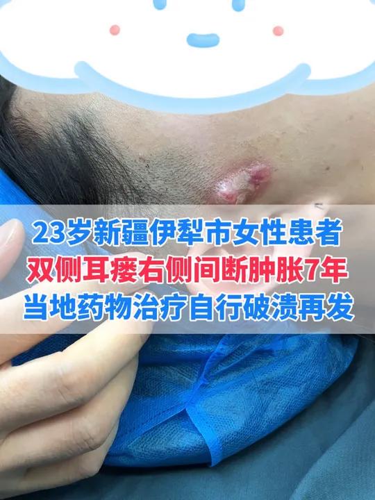 这位新疆伊犁的患者,双侧耳瘘右侧间断肿胀七年,每次都是鱼石脂治疗,这回找到我一次性解决两侧