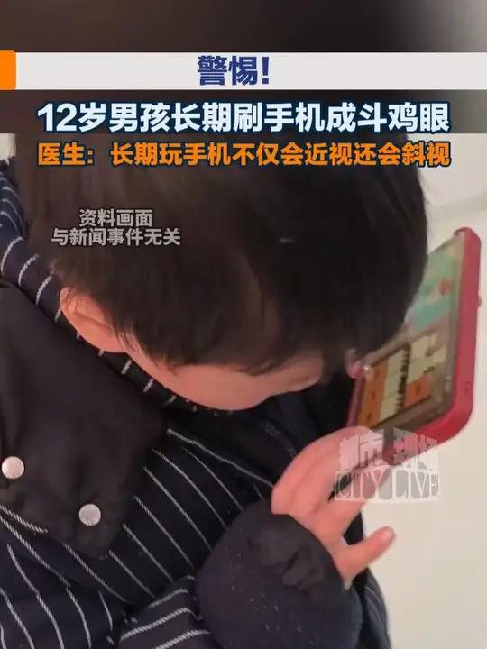 警惕!#12岁男孩长期刷手机成斗鸡眼 医生:长期玩手机不仅会近视还会斜视。#近视#玩手机