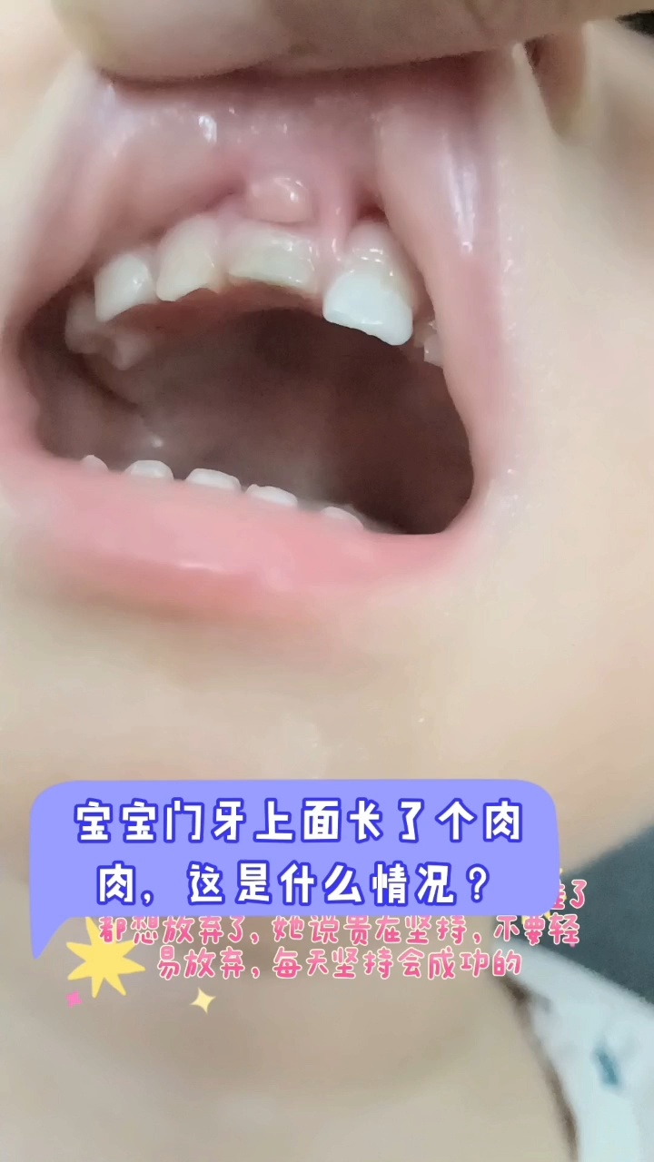 宝宝门牙上面长肉肉是什么情况?