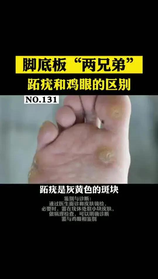 脚底板长的是鸡眼还是跖疣?你到底弄清楚了吗?这个视频告诉你!