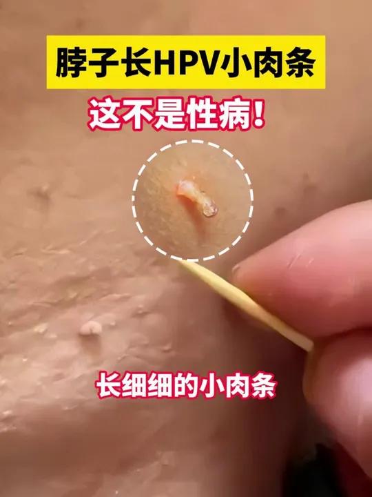 脖子小肉条别揪,这是丝状疣,它不是性病,暴露伤口会传染越来越多