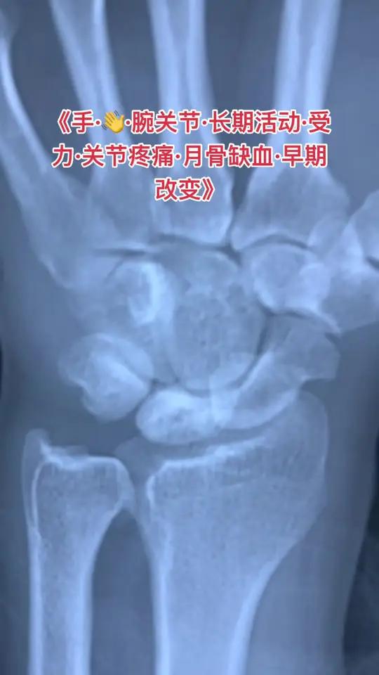 患者的月骨有些硬化和萎缩!?骨是腕关节受力的一个小骨头,长期活动撞击容易出现水肿和缺血改变