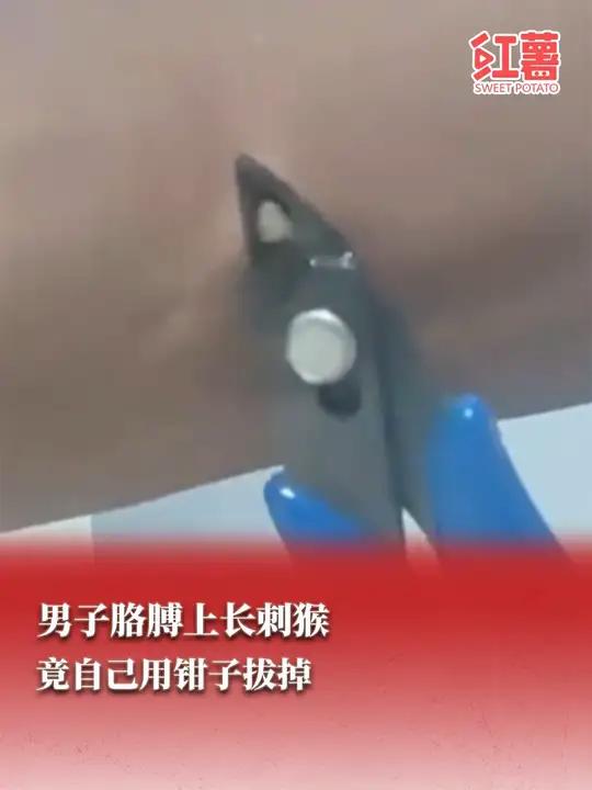 6月8日(发布),安徽。男子胳膊上长了一个小“刺猴”,竟然自己用钳子硬生生的拔掉,隔着屏幕