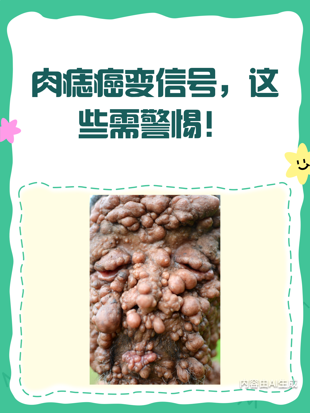肉痣会癌变这些危险信号你一定要知道