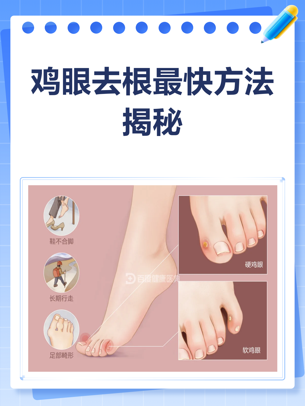 鸡眼去根最快方法