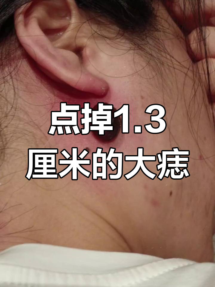 专业点痣技术,轻松去除大肉痣