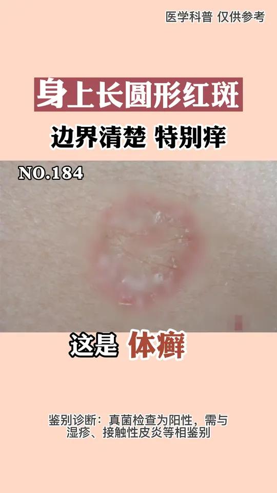 身上起一块块小红斑,这可能是体癣