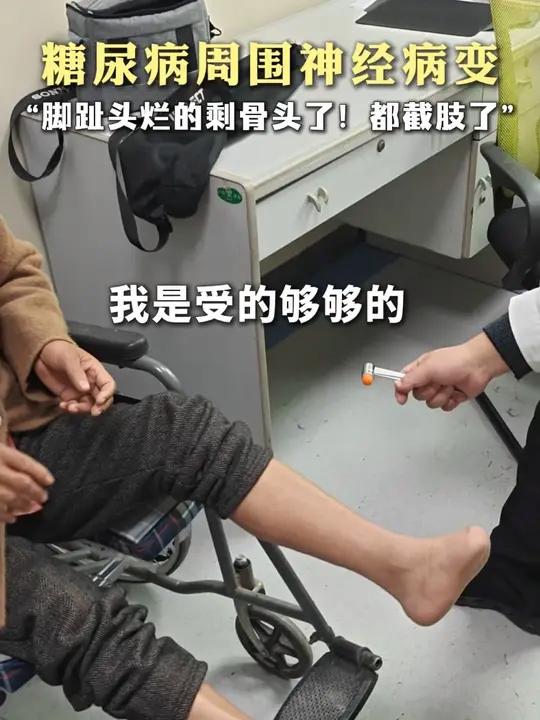 25年糖尿病。神经病变折磨的脚都截肢了,现在脚麻、疼、烫得不敢沾地,双腿像被火烤,脚心又疼