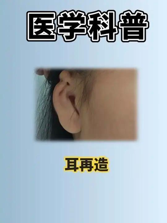 小耳朵 小耳畸形