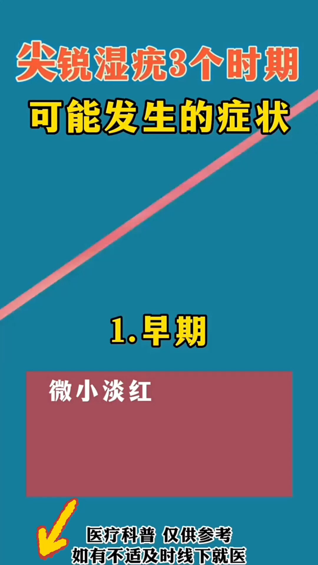 尖锐湿疣初期有哪些症状?怎么辨别真假湿疣
