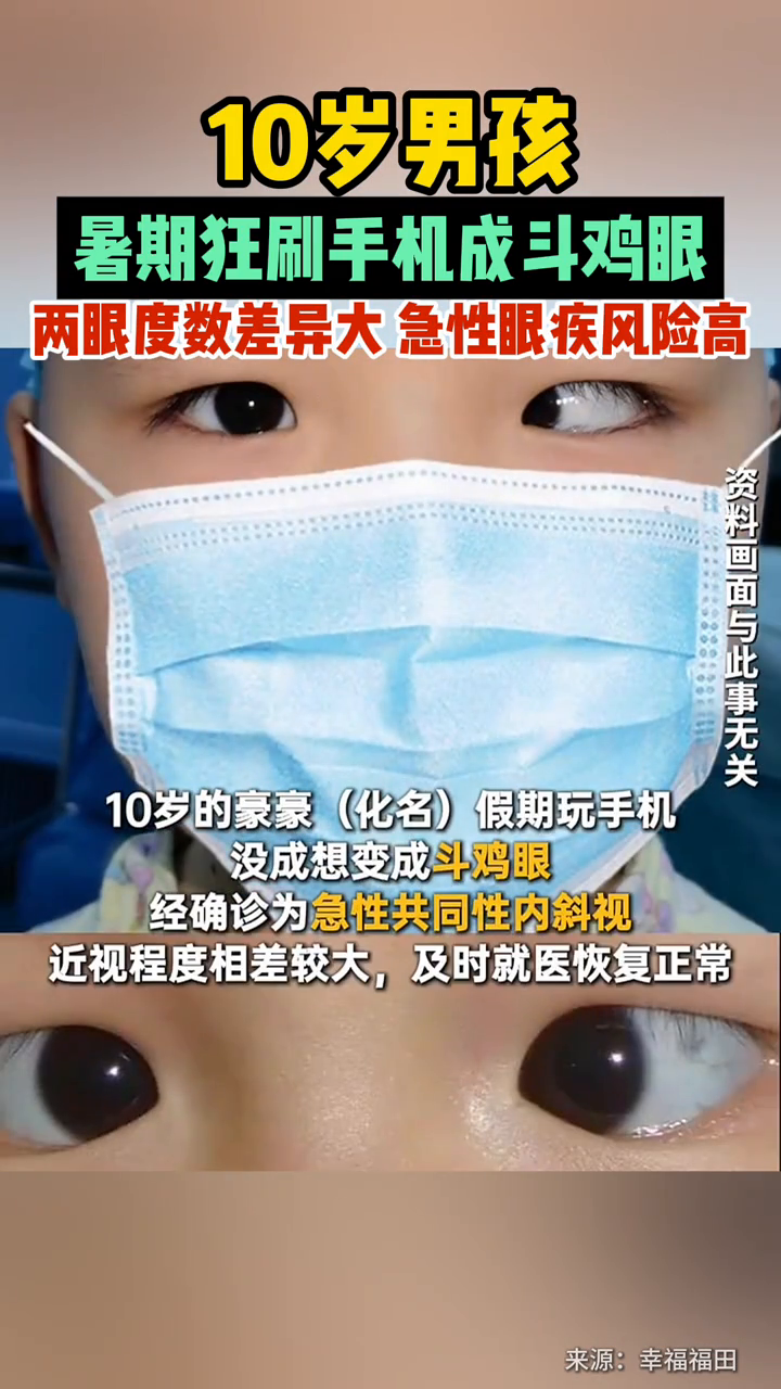 10岁男孩暑期狂刷手机成斗鸡眼,两眼度数差异大