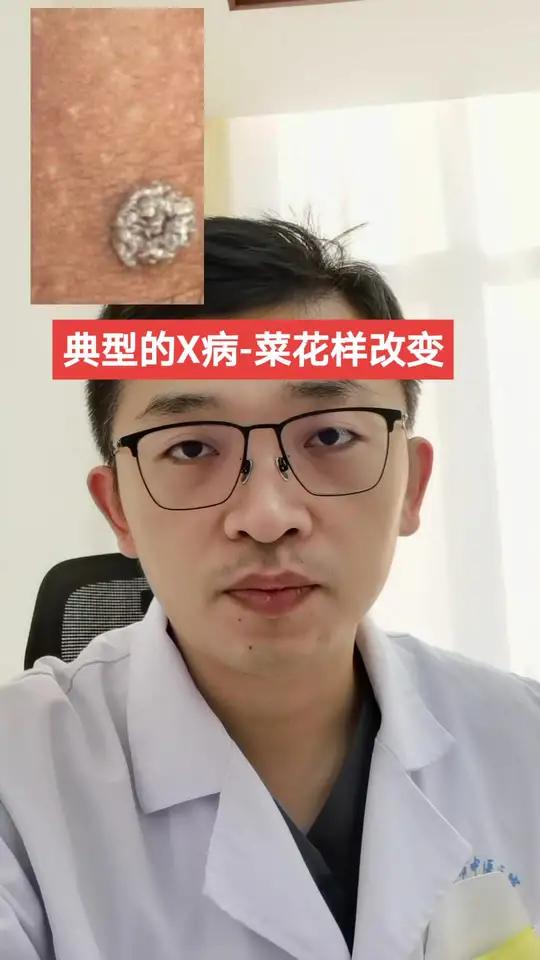 典型的X病-菜花样改变