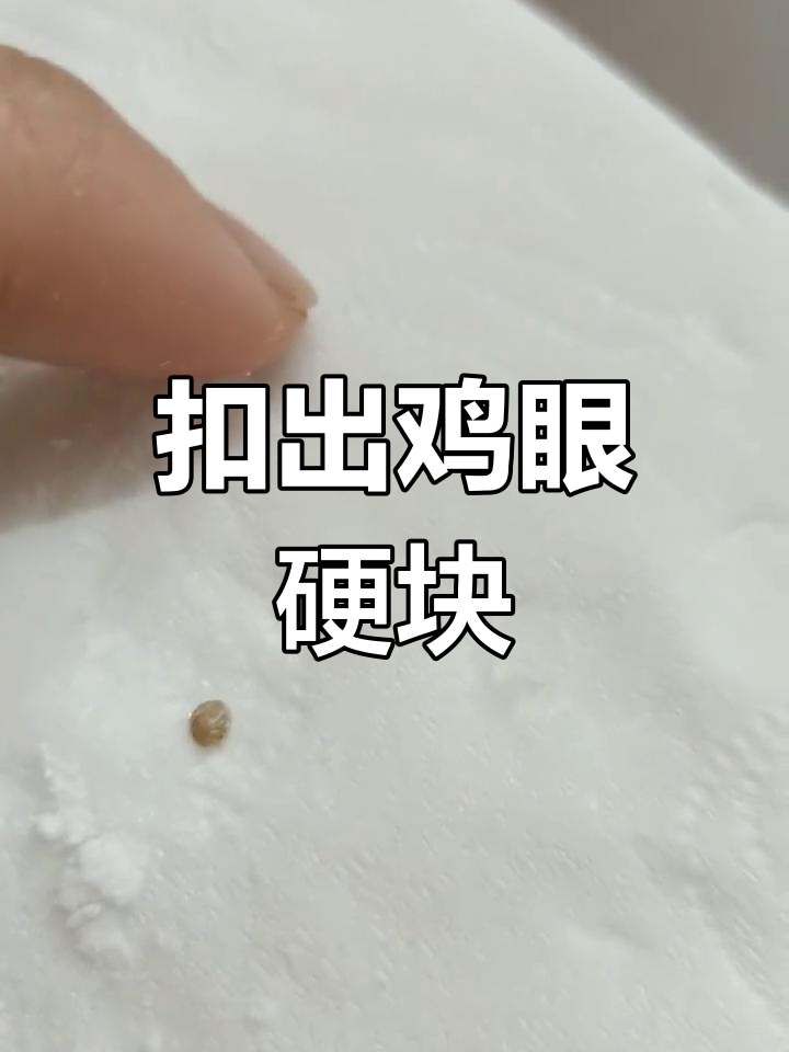 手上鸡眼终于去除,硬块像小石头
