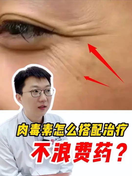 一支肉毒素如何发挥最大作用