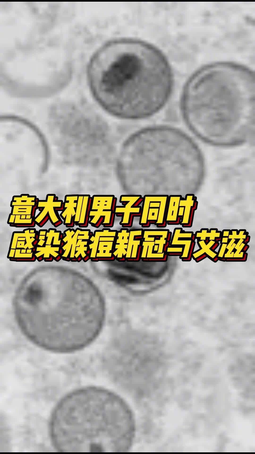 「全球首例!意大利男子同时感染猴痘新冠艾滋」据荷兰媒体当地时间8月23日消息,意大利报告了