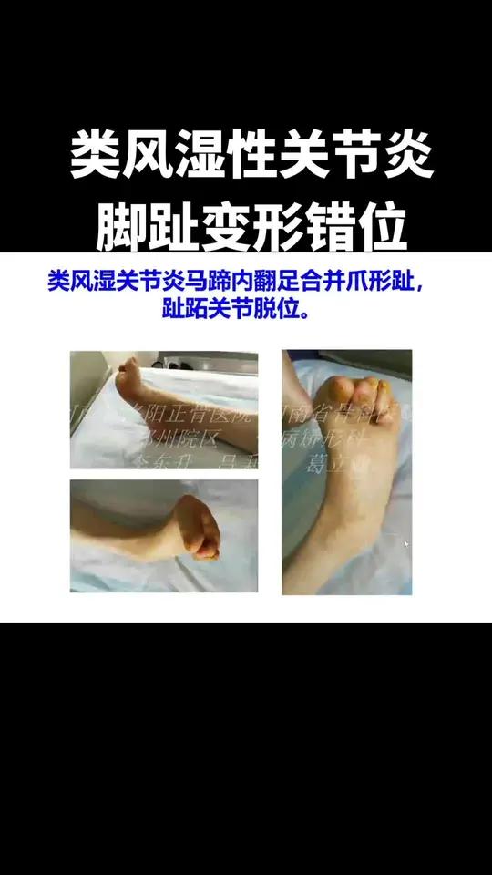 类风湿性关节炎 合并脚趾变形脱位 