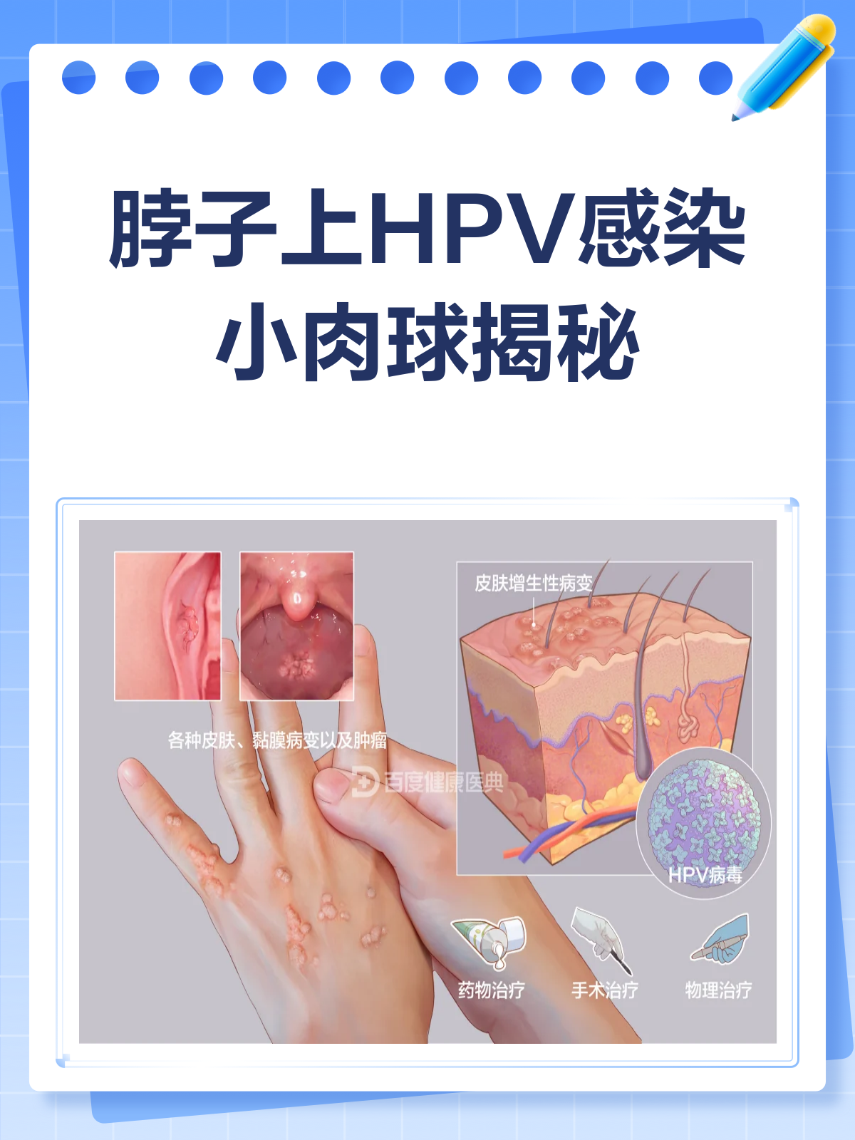 脖子上的“小肉球”,竟是HPV感染?看图识病!