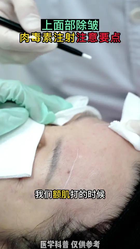 上面除皱,肉毒素 注射这些点要注意了!