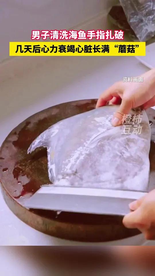 浙江37岁男子清洗海鱼手指扎破,几天后心力衰竭心脏长满“蘑菇”