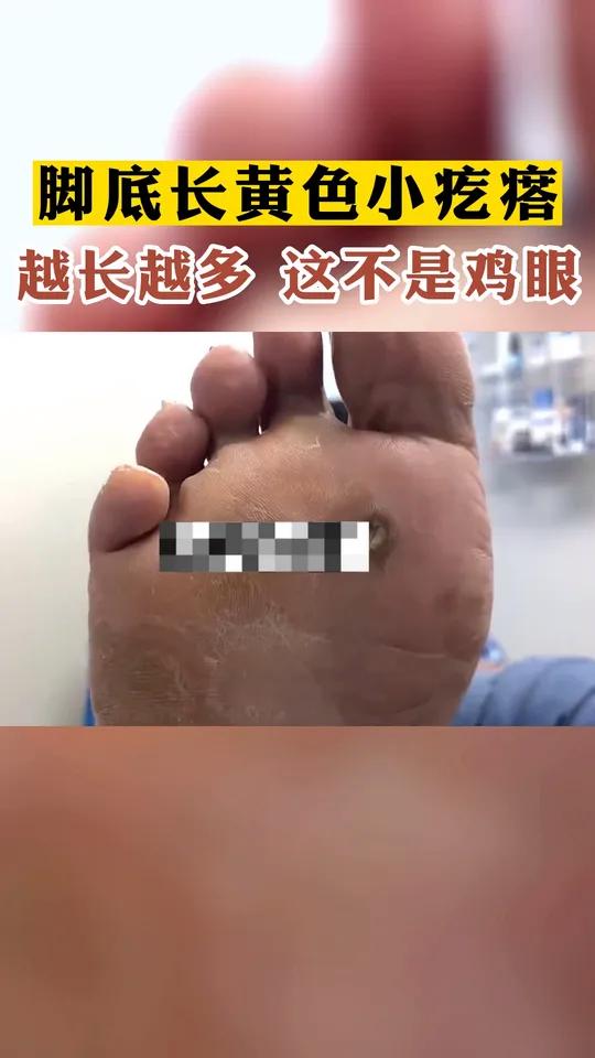 脚上长黄色小疙瘩,这不是鸡眼,千万别乱处理!