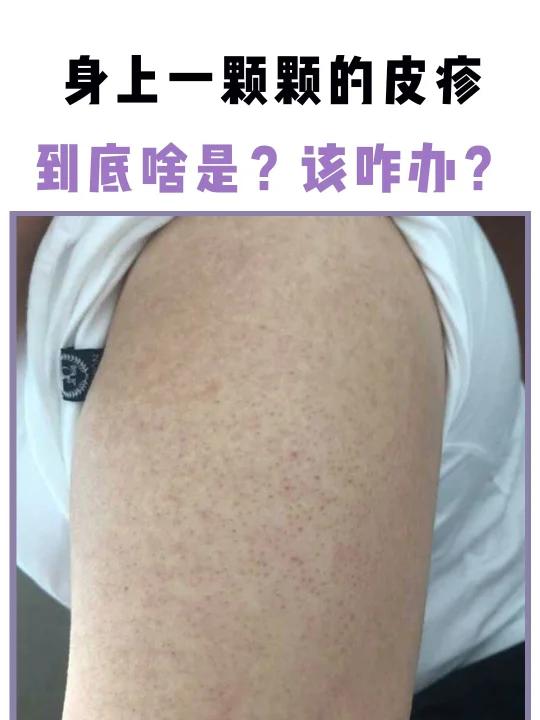 身上一颗颗密密麻麻的小疙瘩,到底是啥?可以这么淡化~鸡皮肤 科普