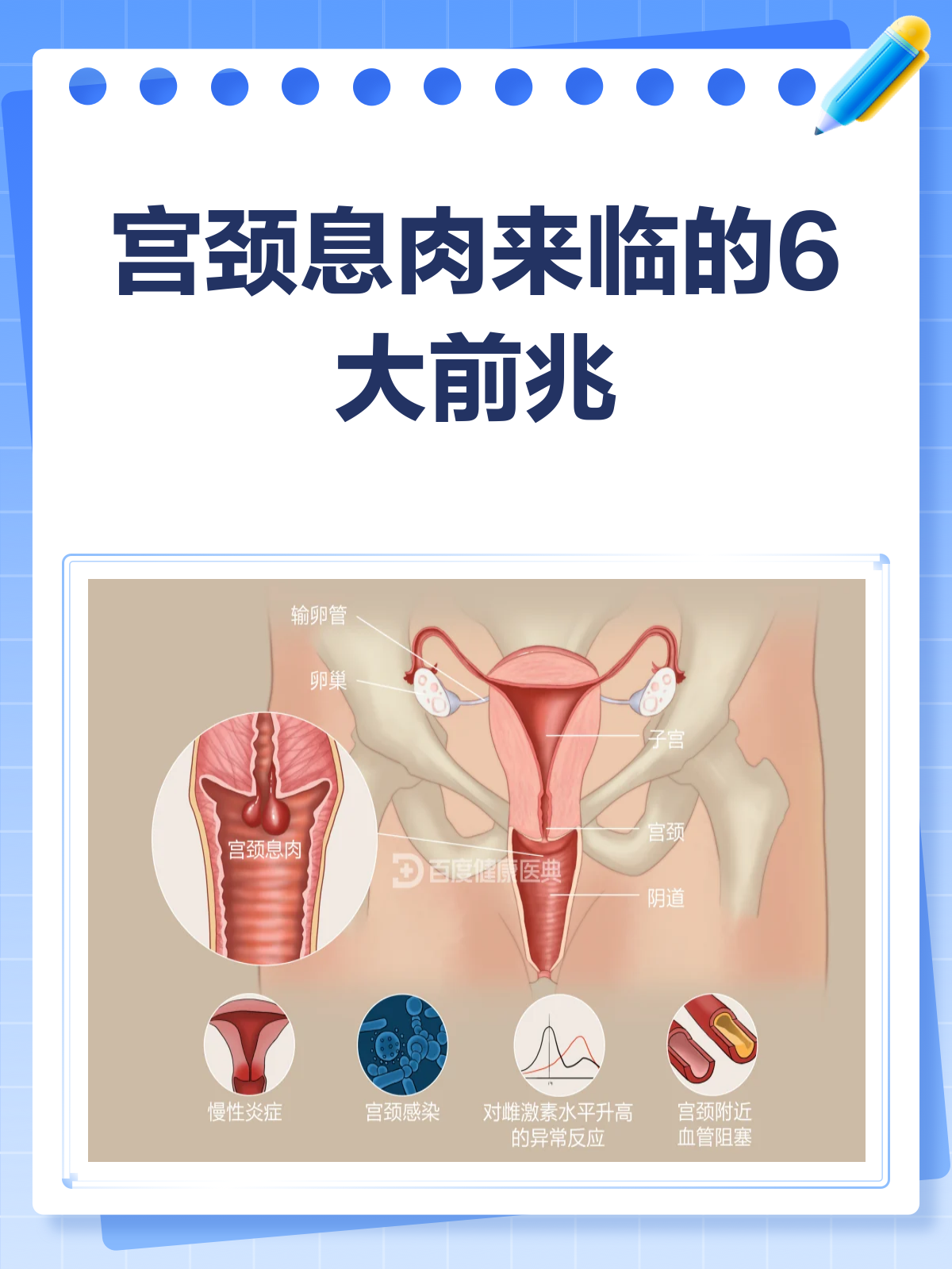 警惕!宫颈息肉来临前的6大信号