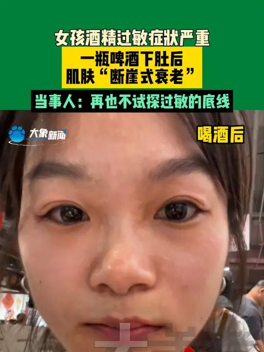 近日,山东。女孩酒精过敏症状严重,一瓶啤酒下肚后,肌肤“断崖式衰老”,当事人:再也不试探过