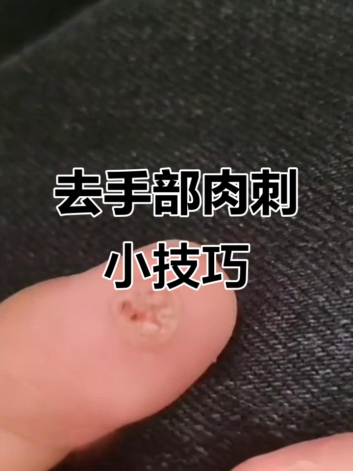 手上长肉刺包？教你轻松去除小黑点