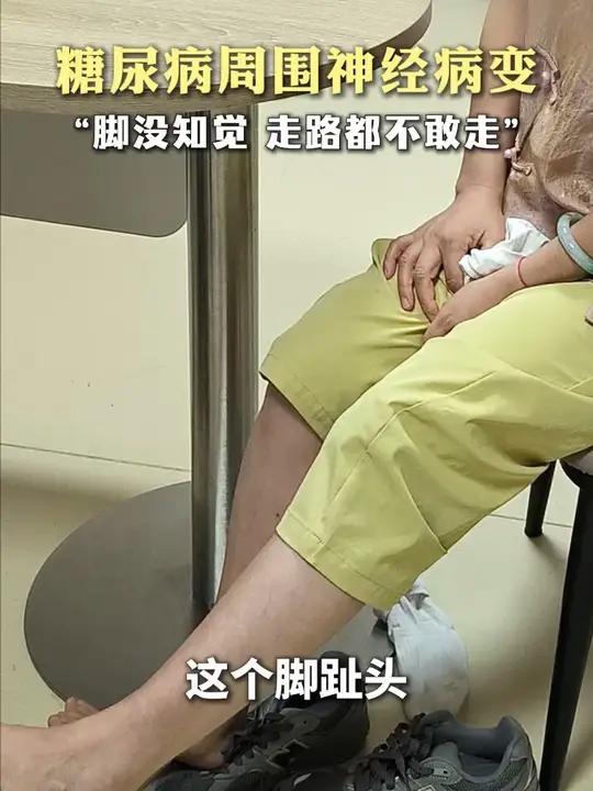 糖尿病5年确诊糖尿病周围神经病变,刚开始脚部失去知觉,都不敢下地走路,治疗了一段时间也没有